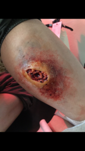 Prosthetic and Application: Roxanne McDanel